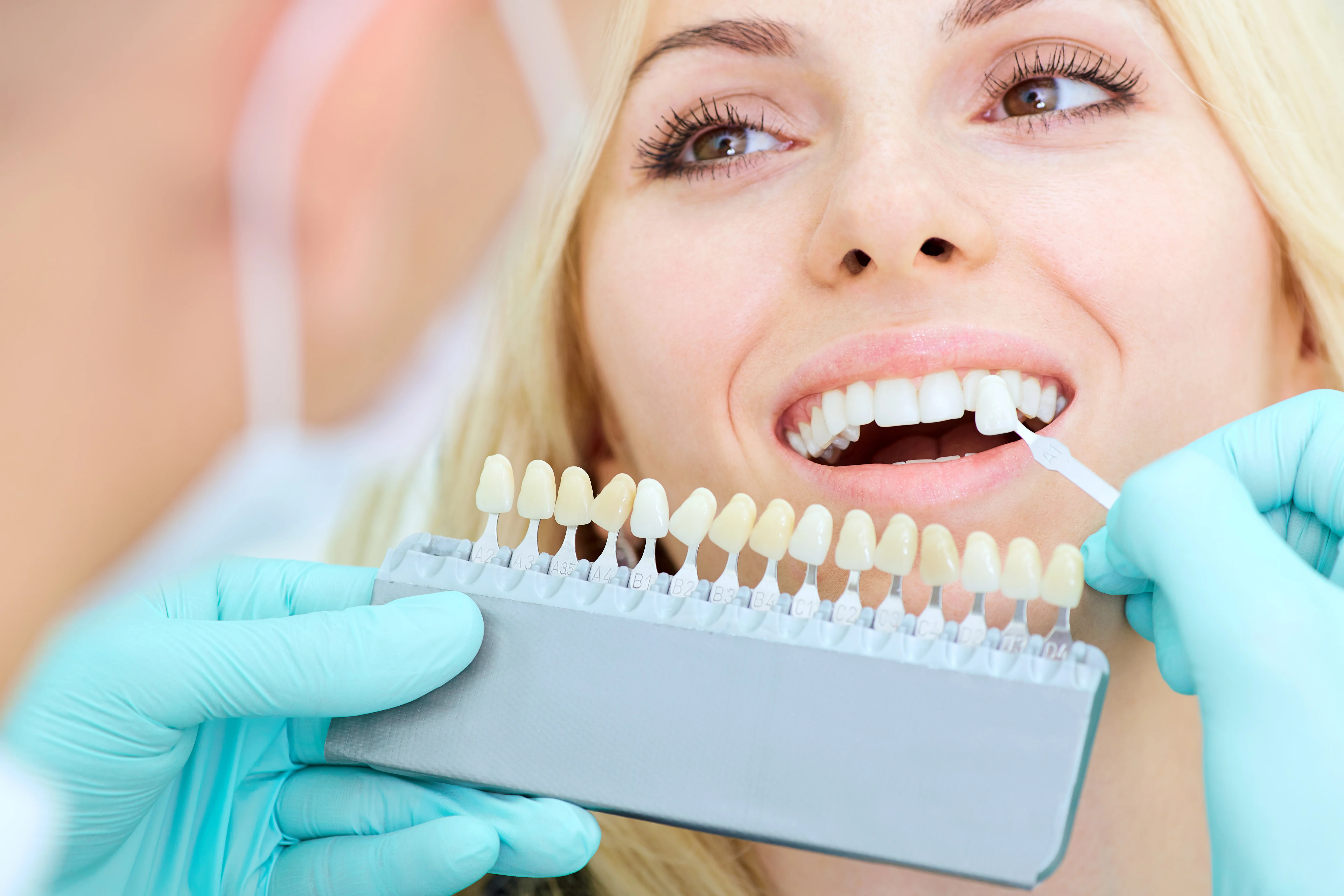 Difference between in-office and at-home teeth whitening